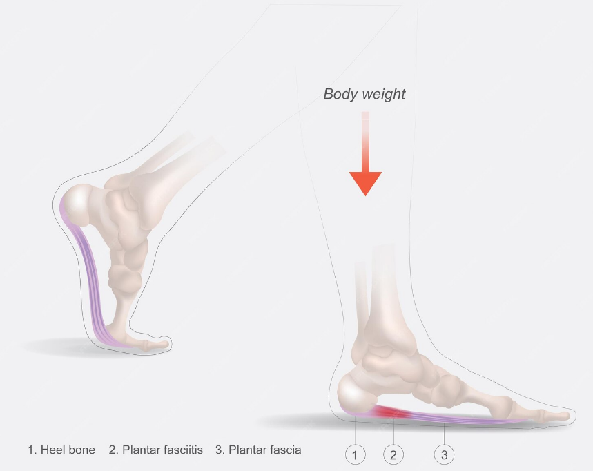 کاردرمانی خار پاشنه.