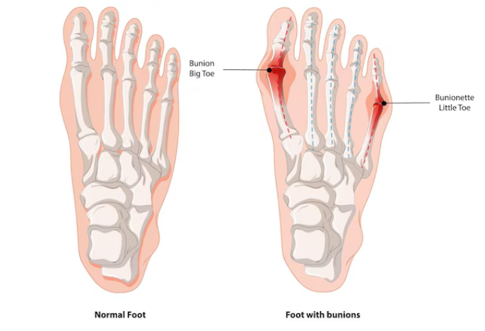 کج شدن انگشت شست پا (بونیون)..
