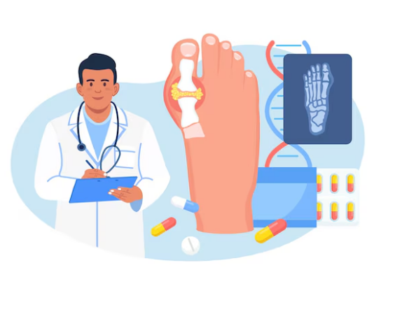 کج شدن انگشت شست پا (بونیون)......