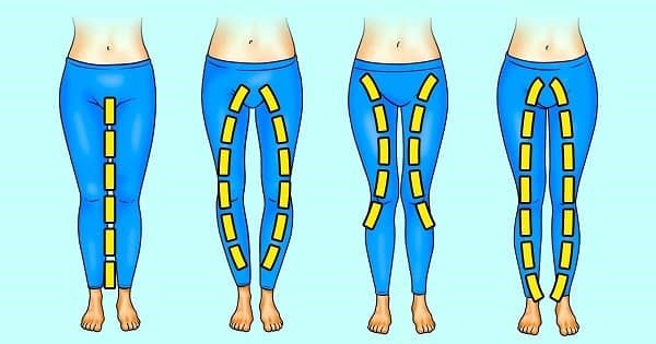 تمرینات اصلاح پای پرانتزی و ضربدری