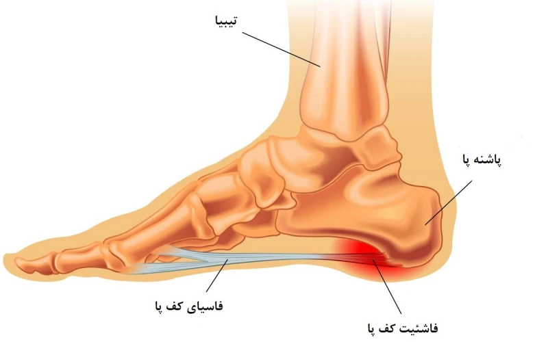 درمان خار پاشنه در کلینیک پاپزشکی