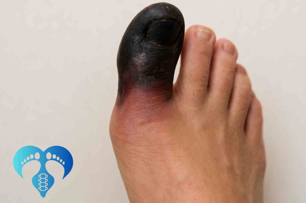 پیشگیری از پای دیابتی در پاپزشکی